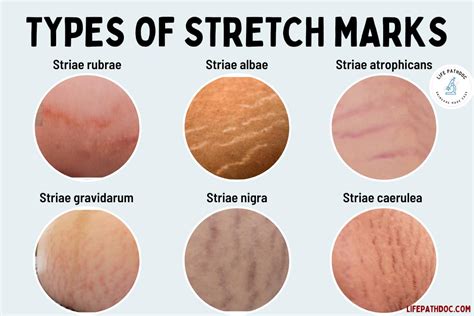 Do Guys Like Stretch Marks on Bum: A Dive into Beauty Standards and Personal Preferences