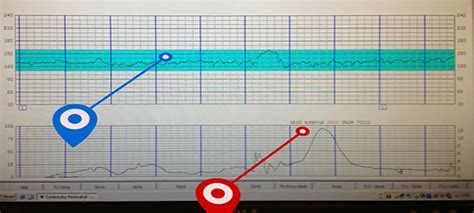 What Do Labor Contractions Look Like on Monitor: A Journey Through the Waves of Birth